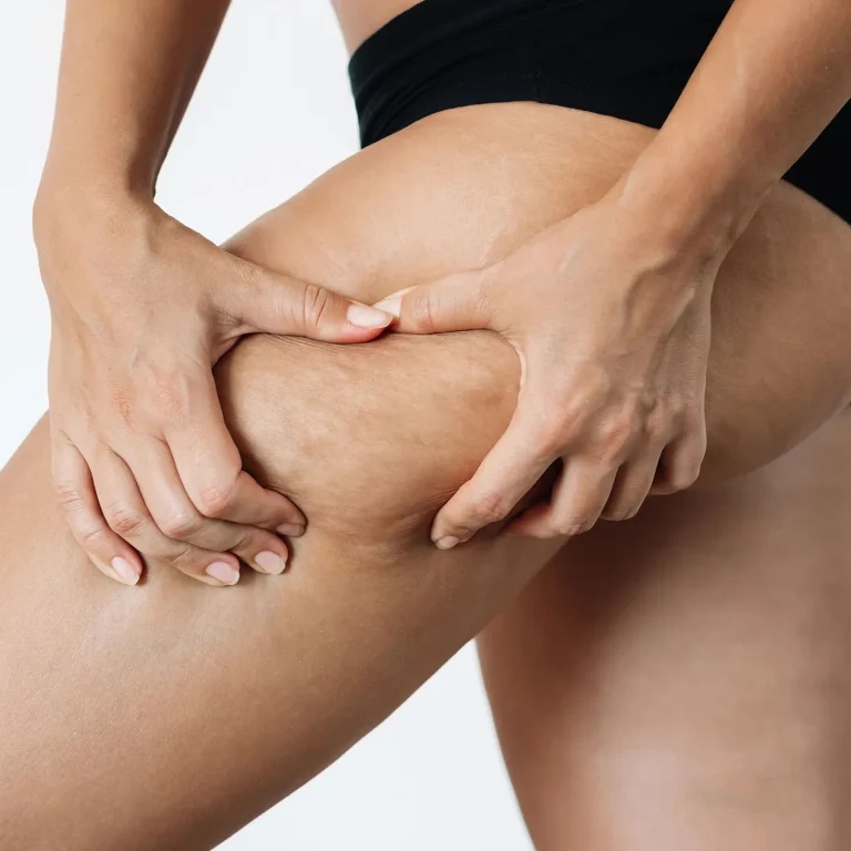 Celulitis 1 copia